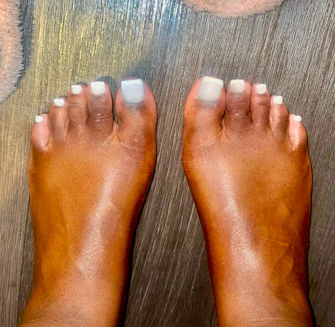 Hammertoe before surgery - bent toe with visible deformity