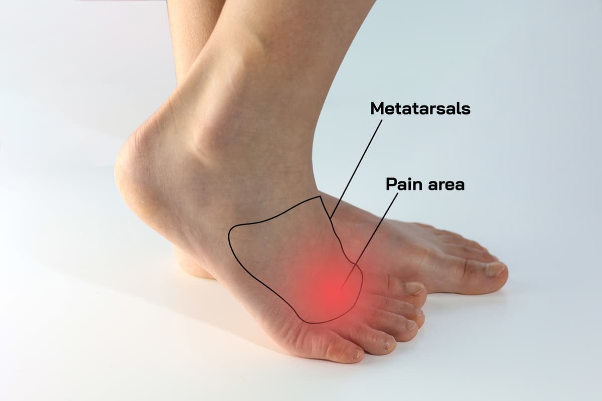 Neuroma in the foot - Morton's neuroma diagram