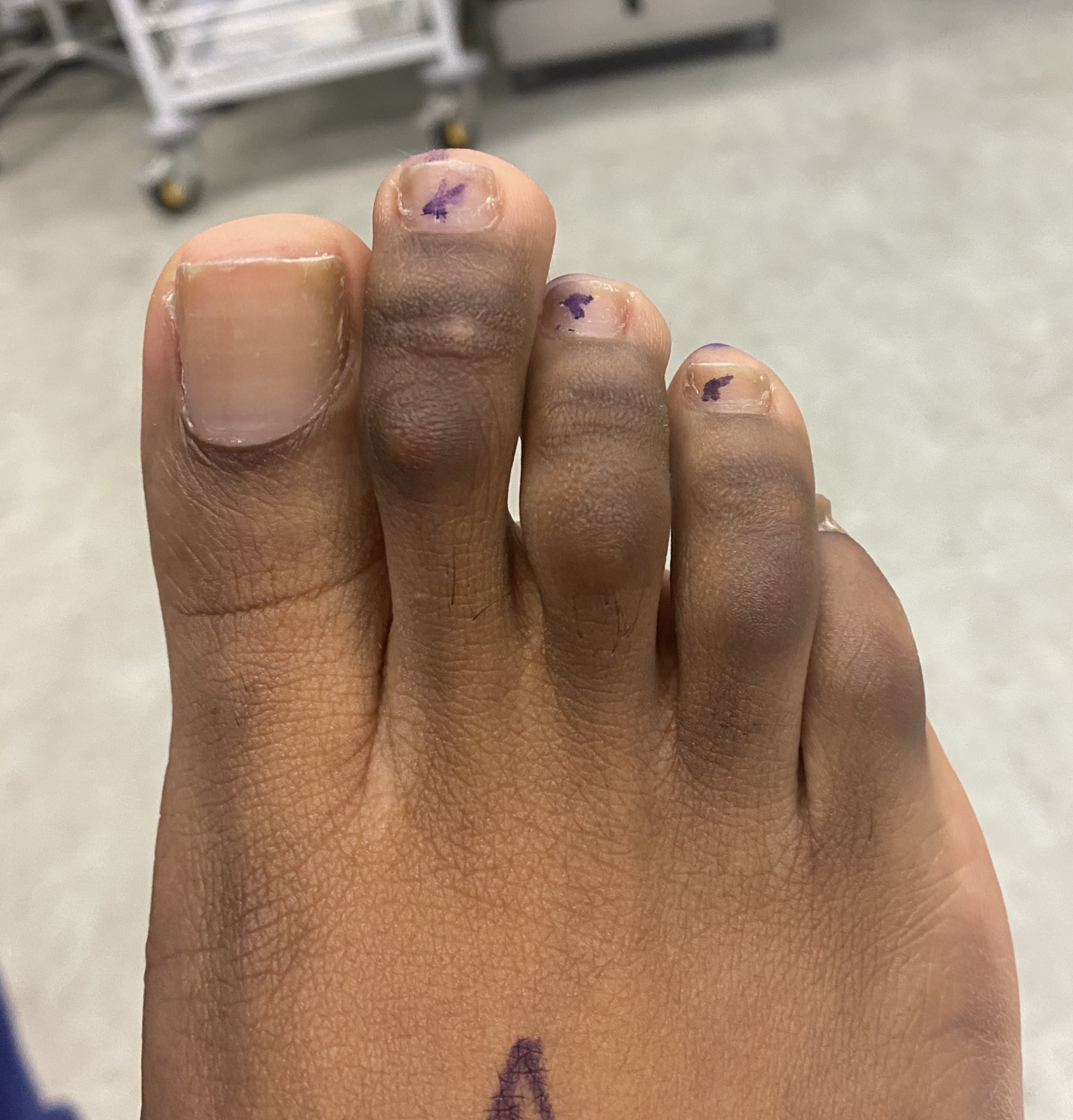 Hammer Toe Exercises You Can Easily Do at Home