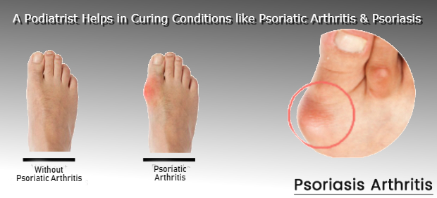 Psoriatic Arthritis & Psoriasis