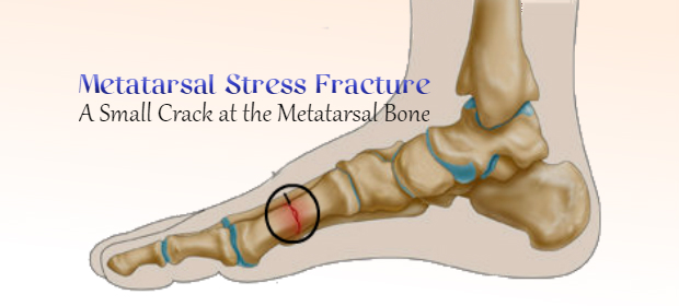 Metatarsal Bone