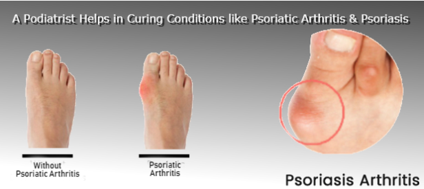 Az arthritis psoriatica