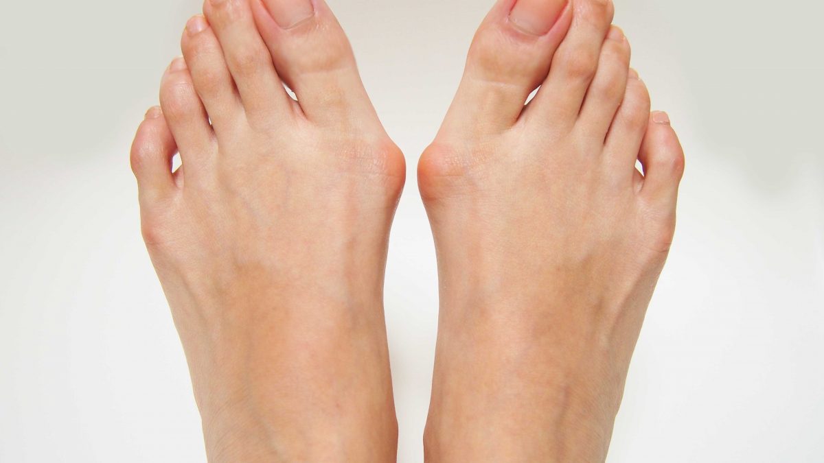 Bunion deformities to both feet